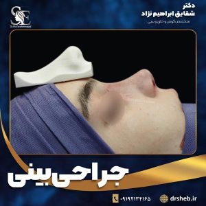 جراحی-بینی-1