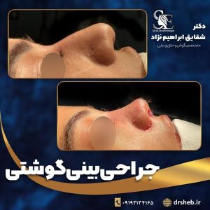 جراحی-بینی-10