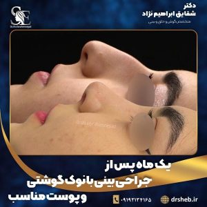 جراحی-بینی-12