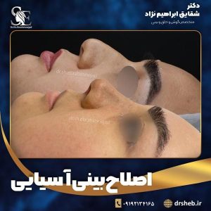 جراحی-بینی-13
