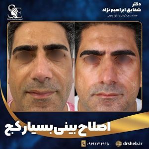 جراحی-بینی-14