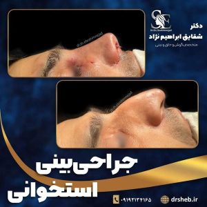 جراحی-بینی-17