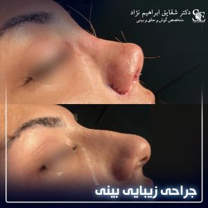 جراحی-بینی-19
