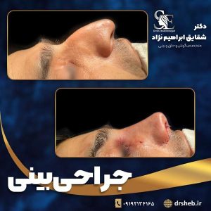 جراحی-بینی-2