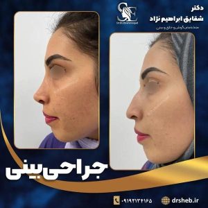 جراحی-بینی-20