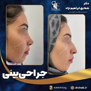 جراحی-بینی-21
