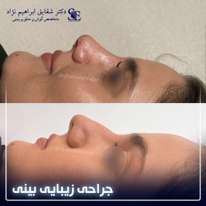 جراحی-بینی-22