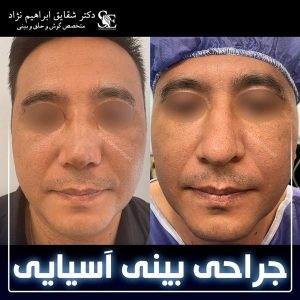 جراحی-بینی-23