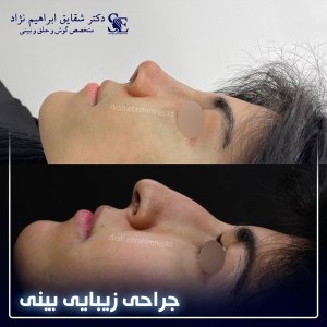 جراحی-بینی-24