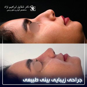 جراحی-بینی-25