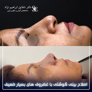 جراحی-بینی-26