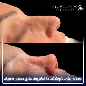 جراحی-بینی-27
