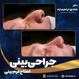 جراحی-بینی-3