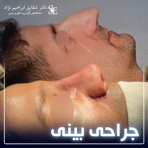 جراحی-بینی-30