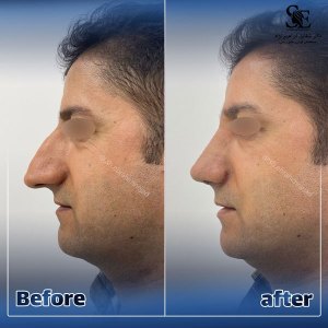 جراحی-بینی-31