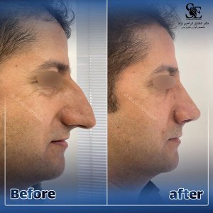جراحی-بینی-32