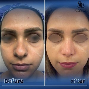 جراحی-بینی-33