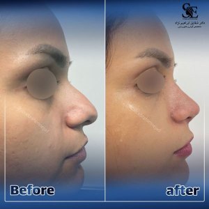 جراحی-بینی-34