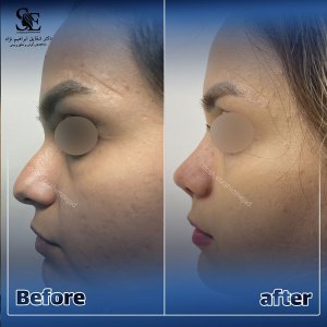 جراحی-بینی-35