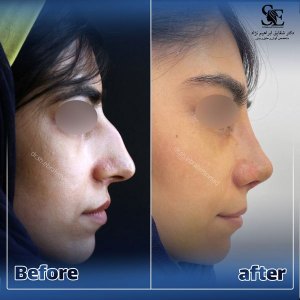 جراحی-بینی-36