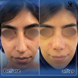 جراحی-بینی-37