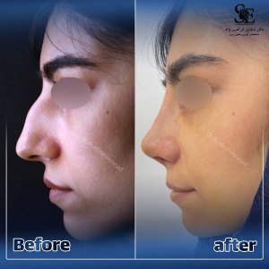 جراحی-بینی-38