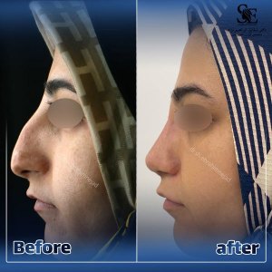 جراحی-بینی-39