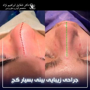 جراحی-بینی-4