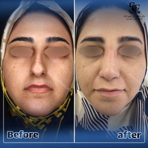 جراحی-بینی-40