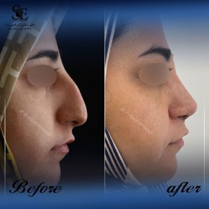 جراحی-بینی-41