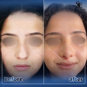 جراحی-بینی-42