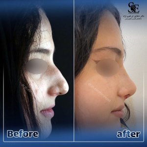 جراحی-بینی-43