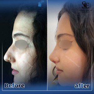 جراحی-بینی-44