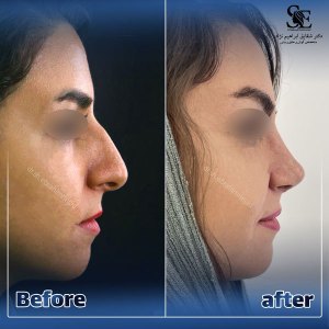 جراحی-بینی-45