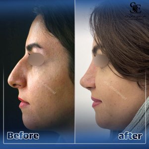 جراحی-بینی-46