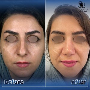 جراحی-بینی-47