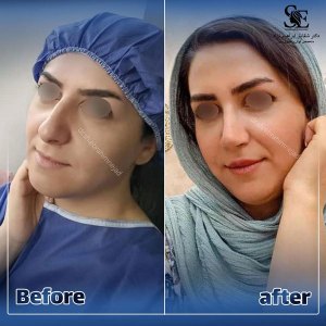 جراحی-بینی-48