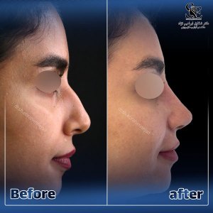 جراحی-بینی-49