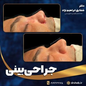 جراحی-بینی-5
