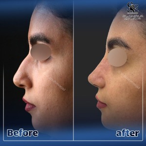 جراحی-بینی-50