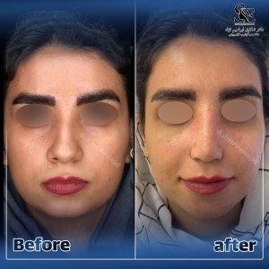 جراحی-بینی-51