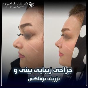 جراحی-بینی-53