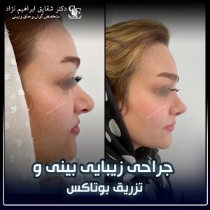 جراحی-بینی-55