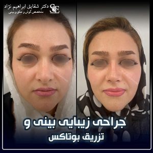 جراحی-بینی-57