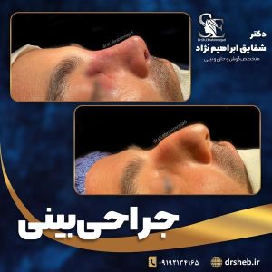 جراحی-بینی-6