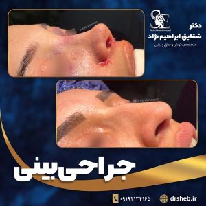 جراحی-بینی-7