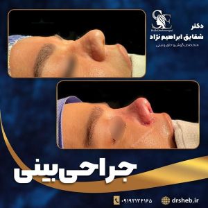 جراحی-بینی-8