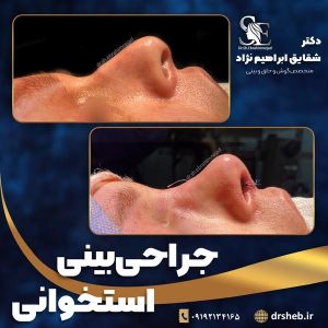 جراحی-بینی-9