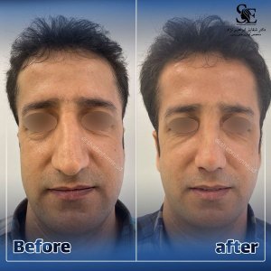 1_جراحی-بینی-30