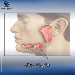 جراحی غدد بزاقی - دکتر ابراهیم نژاد